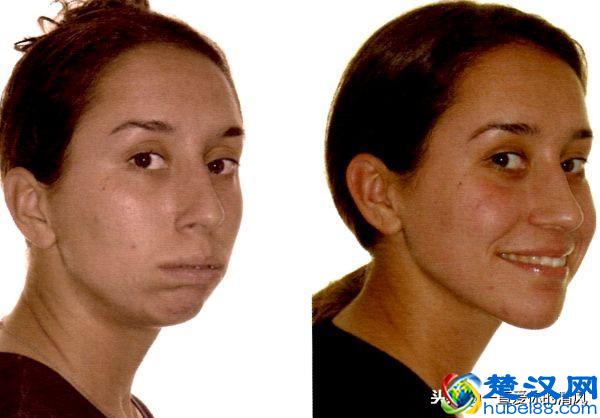 龅牙凸嘴又想变漂亮怎么办？