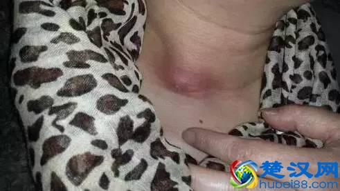 卡了一根鱼刺竟丢了命！鱼刺卡喉后有七处致命点，处处可能致命！