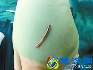 卡了一根鱼刺竟丢了命！鱼刺卡喉后有七处致命点，处处可能致命！