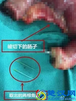 卡了一根鱼刺竟丢了命！鱼刺卡喉后有七处致命点，处处可能致命！