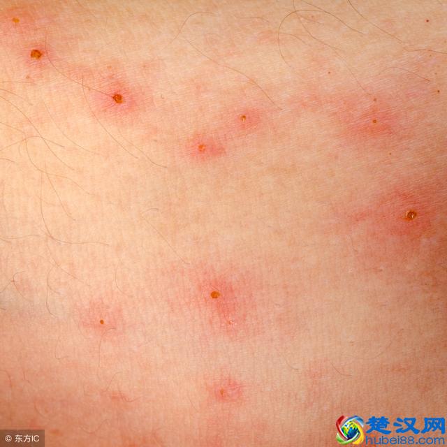 过敏性皮炎的3大危害，生活中如何做到预防过敏性皮炎呢