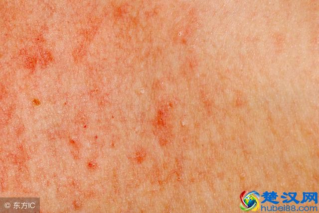 过敏性皮炎的3大危害，生活中如何做到预防过敏性皮炎呢