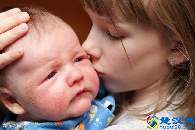 新生儿的脸蛋干燥又脱皮，到底正不正常？