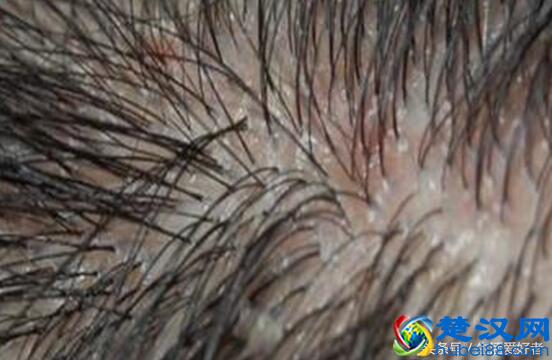 新成果：慢性脱发、脂溢性脱发根治方法推荐