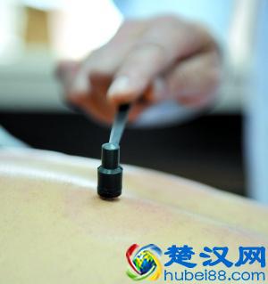 头部脂溢性皮炎,头油,头痒,头屑多,中医用1种针具扣刺