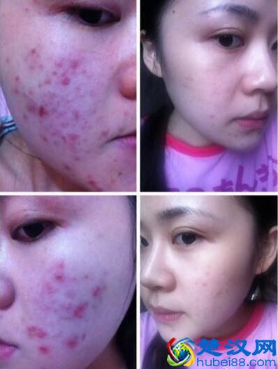 换季长痘痘  看他是怎么有效的祛除多年的痘痘
