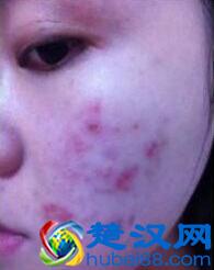 换季长痘痘  看他是怎么有效的祛除多年的痘痘