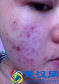换季长痘痘  看他是怎么有效的祛除多年的痘痘