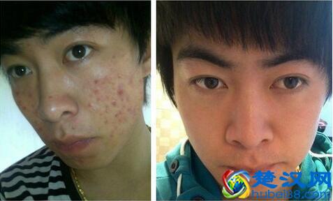 换季长痘痘  看他是怎么有效的祛除多年的痘痘