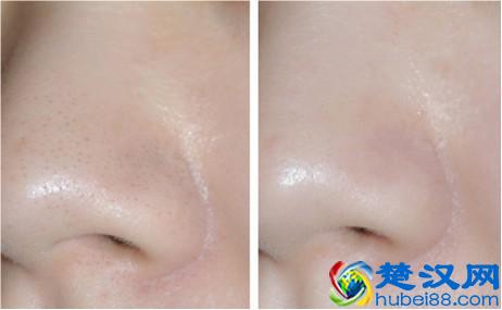 黑头导出液该怎么用呢?