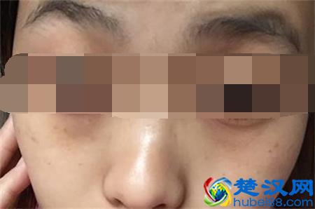 眼睛下面长斑的原因 你知道多少呢?