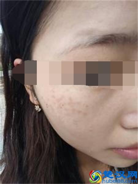 眼睛下面长斑的原因 你知道多少呢?