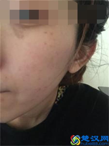 眼睛下面长斑的原因 你知道多少呢?