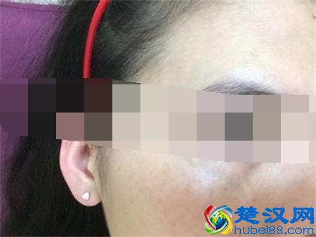 眼睛下面长斑的原因 你知道多少呢?