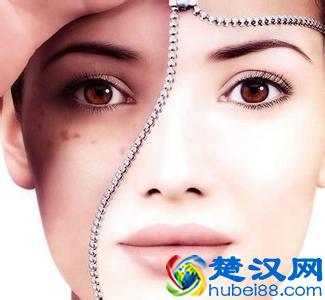 女性蝴蝶斑产生原因及去除方法