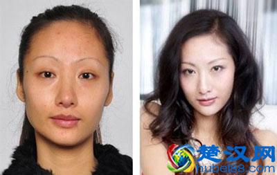 女性蝴蝶斑产生原因及去除方法