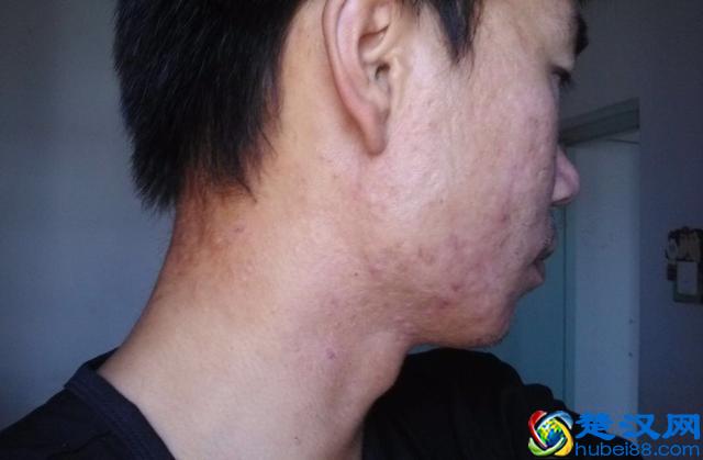 总喜欢挤痘痘，留下满脸的痘印和痘坑，怎么办啊？