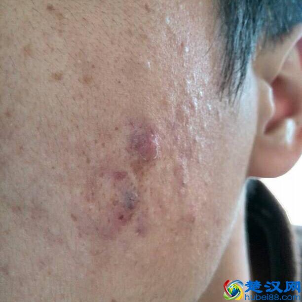 总喜欢挤痘痘，留下满脸的痘印和痘坑，怎么办啊？