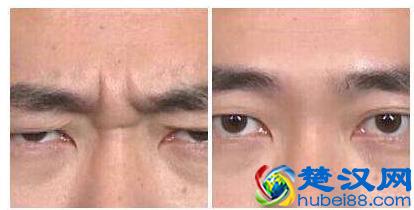 川字纹让你看上去很凶?这3个小步骤能消除川字纹,还能缓解疲劳