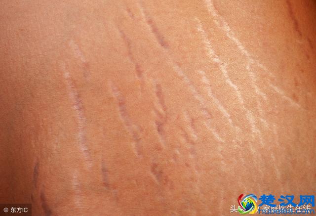 怎么淡化生长纹？不妨试试这5个方法，还你光滑美白皮肤
