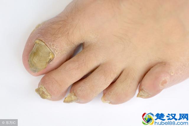 导致灰指甲产生的因素有很多，预防灰指甲的方法这里找