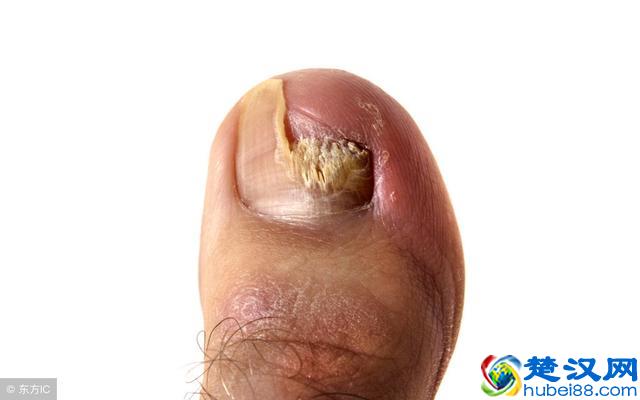 导致灰指甲产生的因素有很多，预防灰指甲的方法这里找