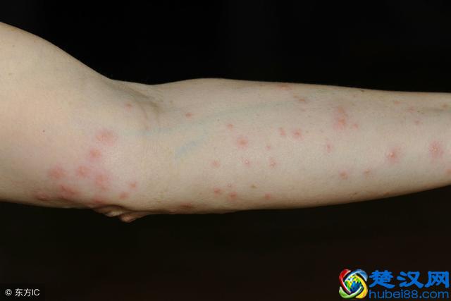 皮肤过敏怎么办？生活中常见的过敏原及防护