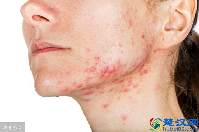 皮肤过敏怎么办？生活中常见的过敏原及防护