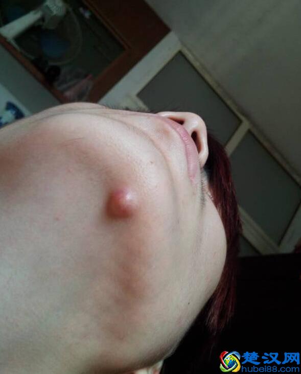 下巴长痘痘隐藏的六大原因是什么？怎么调理呢？