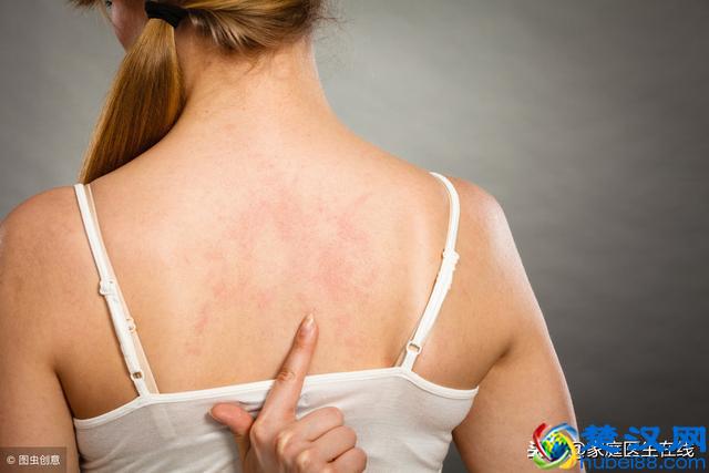 被虫子叮咬要进行处理吗？被这几类虫子咬到，麻烦不断