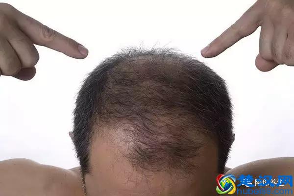 头顶上的头发少怎么办呢？告别秃顶从了解根源开始！