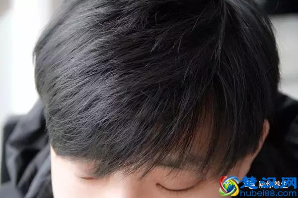 头顶上的头发少怎么办呢？告别秃顶从了解根源开始！