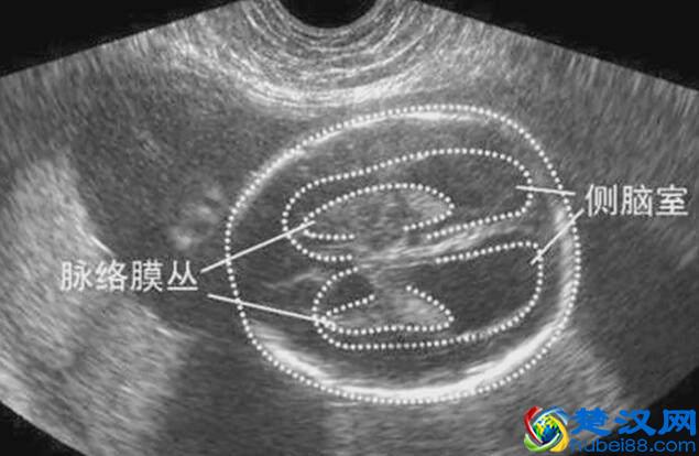 四维彩超那么贵，准妈妈要看懂，不然钱白花了！