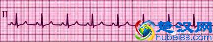 这么教你看心电图，还有什么理由看不懂？