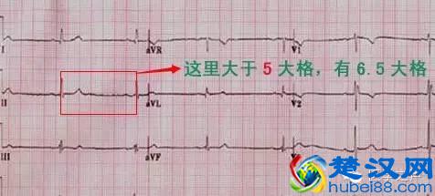 这么教你看心电图，还有什么理由看不懂？