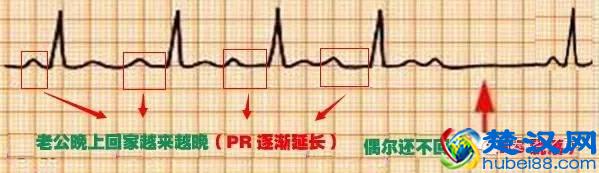 这么教你看心电图，还有什么理由看不懂？