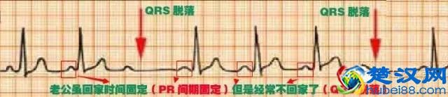 这么教你看心电图，还有什么理由看不懂？