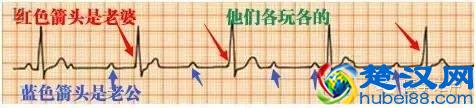这么教你看心电图，还有什么理由看不懂？