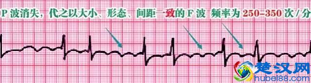 这么教你看心电图，还有什么理由看不懂？