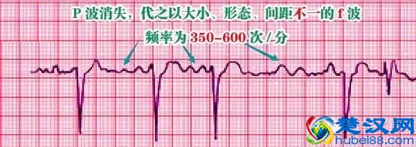 这么教你看心电图，还有什么理由看不懂？