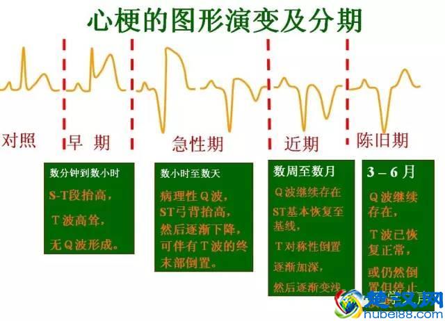 这么教你看心电图，还有什么理由看不懂？