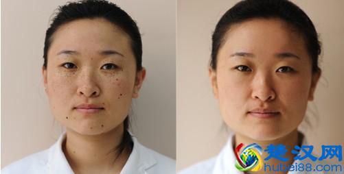 女性的天敌——色斑 教你怎样去除它！