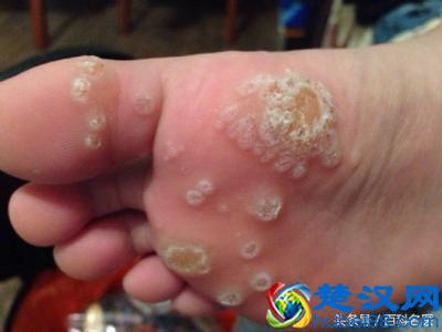 脚底长鸡眼，一走路就疼？中医教你2个让鸡眼自行脱落的小偏方！