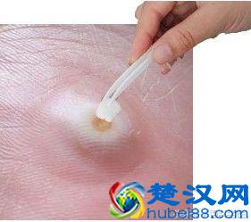 脚底长鸡眼，一走路就疼？中医教你2个让鸡眼自行脱落的小偏方！