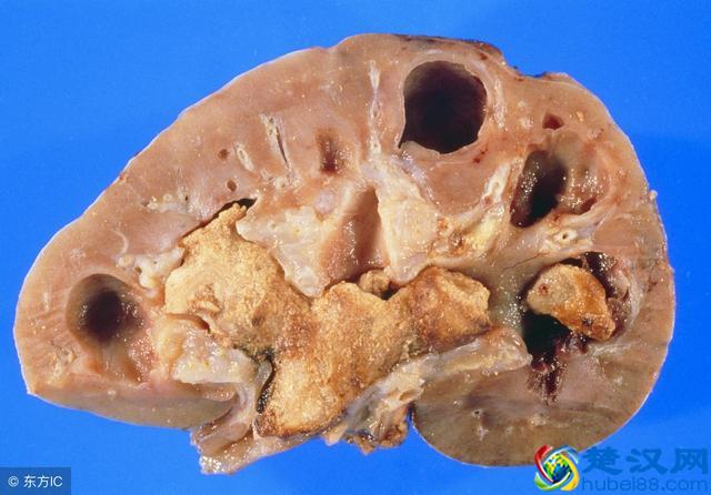 肾结石是怎么导致的？有这几个坏习惯的人十有八九跑不掉