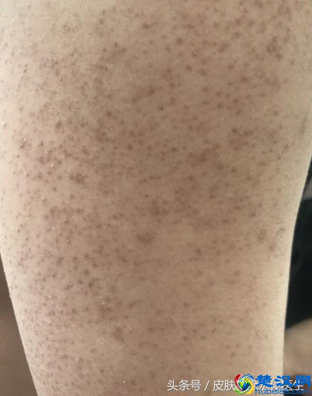 鸡皮肤太难看了，有什么好的办法可以根治吗？