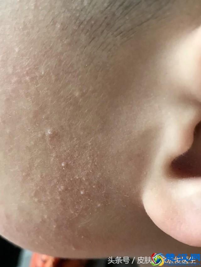 鸡皮肤太难看了，有什么好的办法可以根治吗？