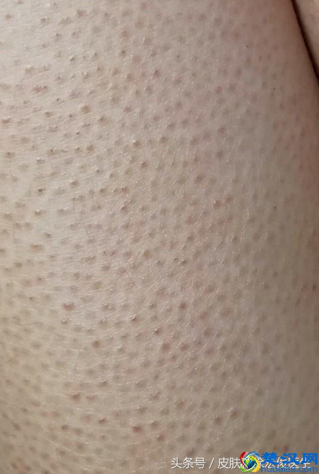 鸡皮肤太难看了，有什么好的办法可以根治吗？