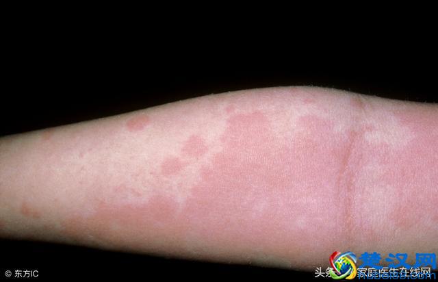 荨麻疹是由什么引起的？这4个“祸首”，哪个都别小看