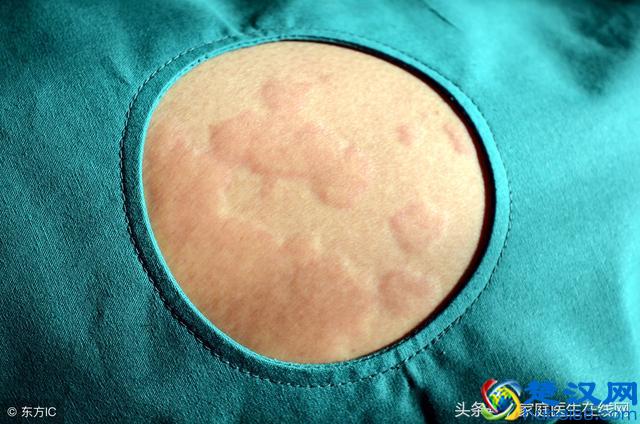 荨麻疹是由什么引起的？这4个“祸首”，哪个都别小看